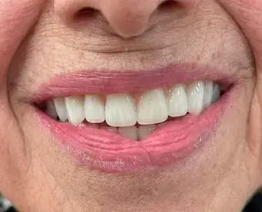 Paciente da IOEX sorrindo após reabilitação com prótese protocolo em Lavras