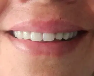 Sorriso reabilitado com prótese protocolo em paciente da IOEX