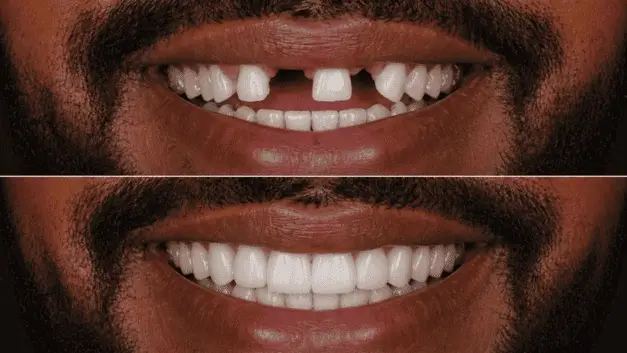 Resultado antes e depois de prótese protocolo realizada na clínica IOEX em Lavras