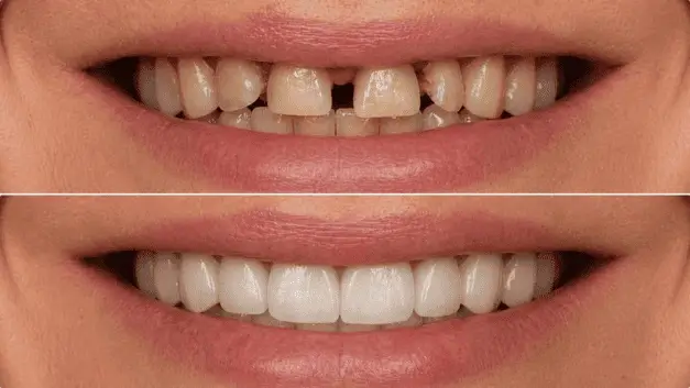 Resultado antes e depois de prótese protocolo realizada na clínica IOEX em Lavras