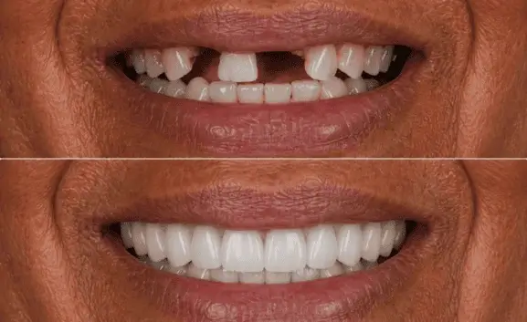 Resultado antes e depois de prótese protocolo realizada na clínica IOEX em Lavras