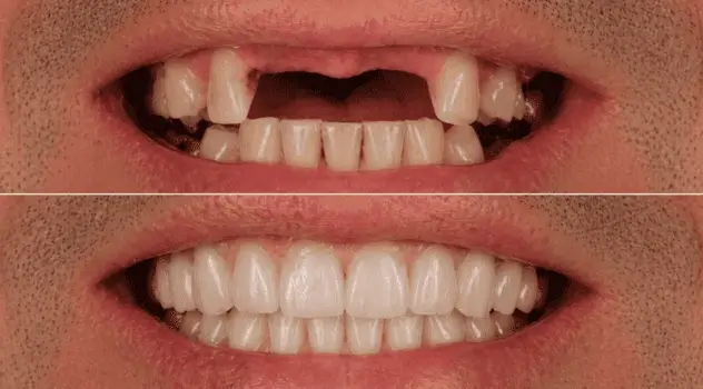 Resultado antes e depois de prótese protocolo realizada na clínica IOEX em Lavras