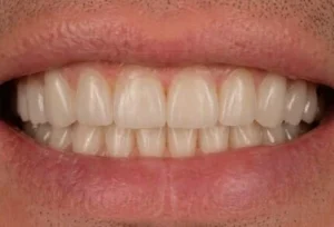 Resultado do tratamento com prótese protocolo com dentes alinhados e naturais IOEX